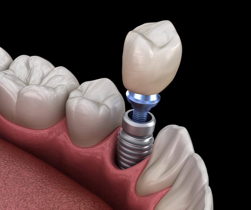Charles City Dentist Looks At Dental Implant Qualifications Central Park