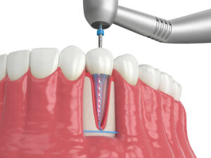 charles city root canal