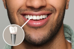 charles city dental implants