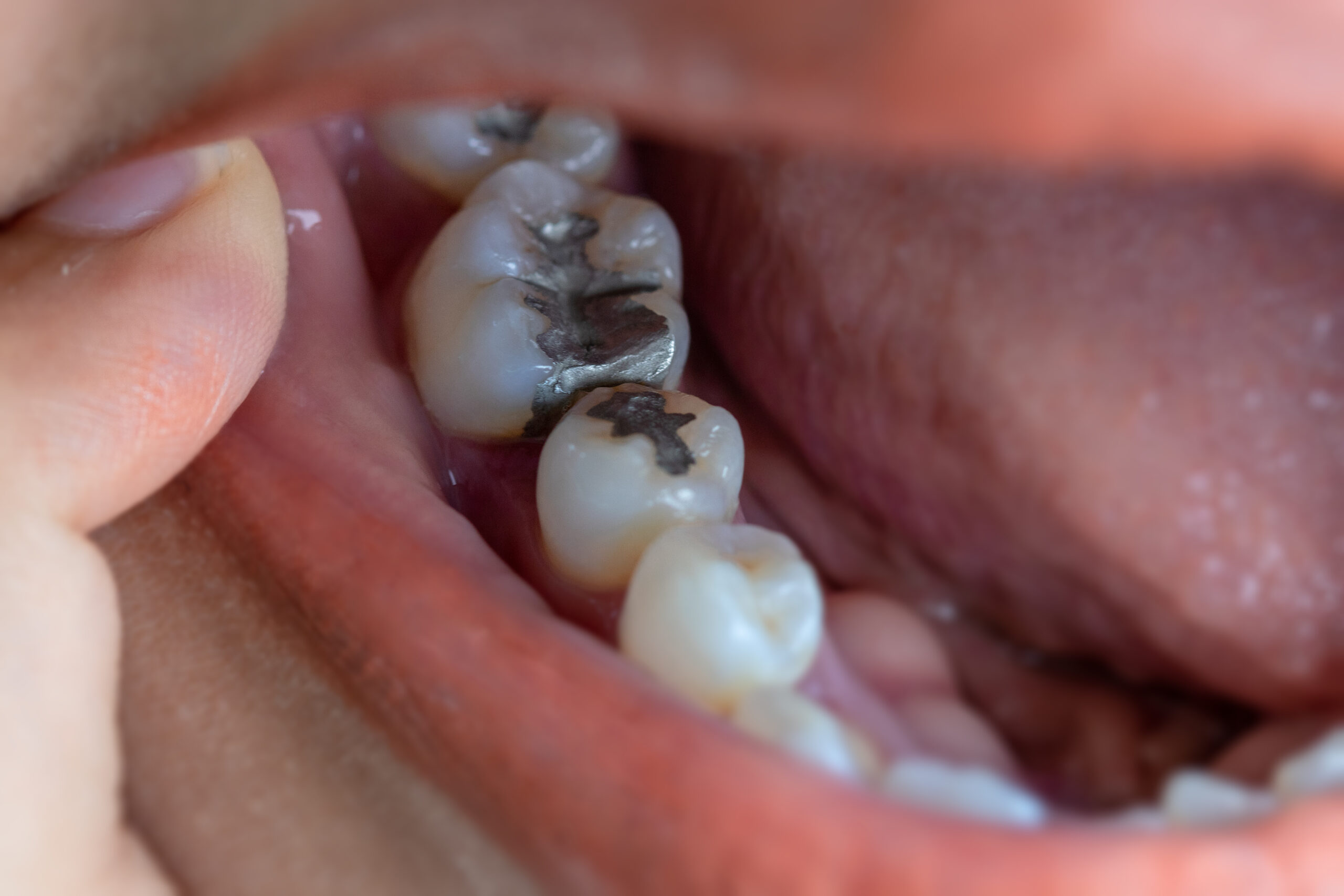 Charles City, IA, dentist offers composite resin and amalgam fillings 